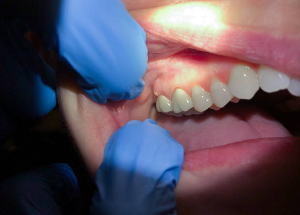 Best Emergency Gum Treatment in Venice, FL